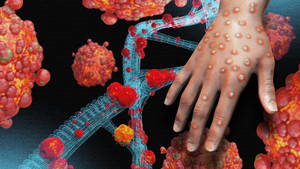 Triệu chứng của bệnh đậu mùa khỉ 