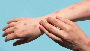 Ca đậu mùa khỉ đầu tiên ở Việt Nam sức khỏe ổn định, ăn uống tốt, lên cân