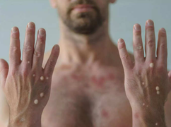 Đậu mùa khỉ có phải là bệnh lây qua đường tình dục?