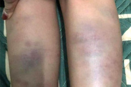 Đà Nẵng: Học sinh lớp 1 bầm tím chân tay do bị bạn cùng lớp đánh