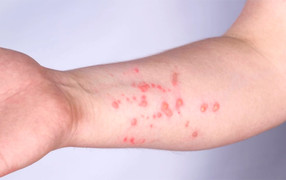 Chăm sóc và điều trị đậu mùa khỉ thế nào?