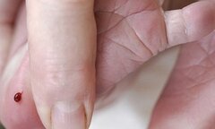 Xét nghiệm lấy máu gót chân trẻ sơ sinh có thể phát hiện được bệnh gì?