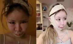 Bé gái 9 tuổi bị mẹ đẻ ép cắt mí, làm mũi, nâng ngực