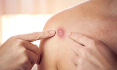 Ghi nhận ca nghi mắc đậu mùa khỉ tại Đắk Lắk, Bộ Y tế chỉ đạo khẩn