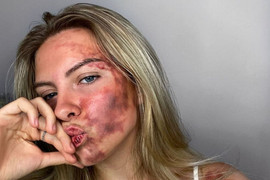 Mắc bệnh lạ gây nên vết bầm khắp mặt, cô gái trẻ có quyết định đáng ngưỡng mộ