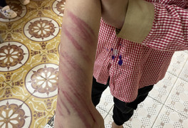 Hải Phòng: Học sinh lớp 2 nghi bị bạn trai của mẹ đánh đập, bầm tím khắp người