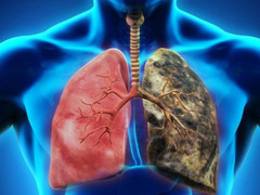 Những người thuộc nhóm nguy cơ cao mắc ung thư phổi