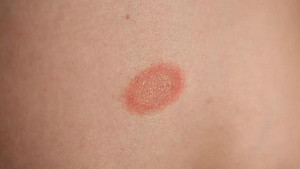 Bệnh nhân vảy nến tuyệt đối không uống các loại nước này