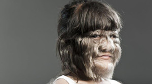 Bệnh người sói - y học vẫn chưa tìm ra cách chữa trị triệt để