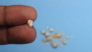 Sỏi thận ảnh hưởng nghiêm trọng tới khả năng sinh lý ở nam giới