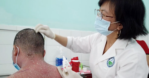Nhiều trường hợp nhập viện do sử dụng thuốc chữa vảy nến trên mạng