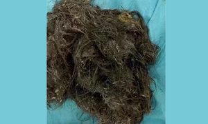 Thiếu nữ Trung Quốc trọc đầu vì ăn tóc