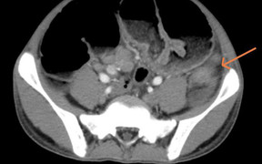 Vào viện vì đau bụng, bé 15 tuổi phát hiện mắc ung thư