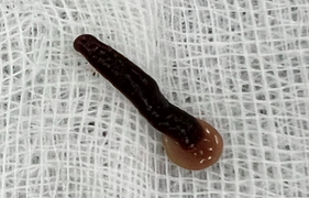 Đỉa sống trong mũi khiến người đàn ông khó thở, chảy máu