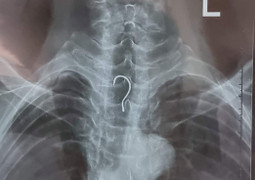 Cụ ông 83 tuổi mắc lưỡi câu trong bụng