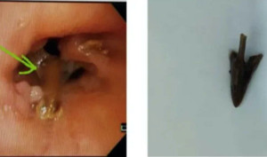 Người đàn ông ở Hà Nội đau ngực, sốt và khó thở kéo dài chỉ vì mảnh mỏ gà