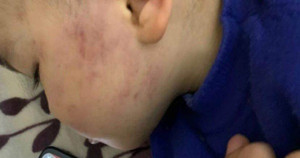 Bé trai 2 tuổi bị giáo viên tát bầm tím một bên má