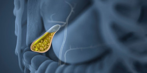 Đi khám vì đau lưng, người phụ nữ sửng sốt khi bác sĩ gắp ra 382 viên sỏi