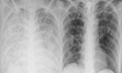 Lạm dụng corticoid tự điều trị cúm, người phụ nữ viêm phổi, suy đa tạng