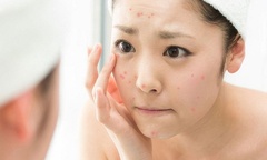 Da bị mụn mãi không khỏi, bác sỹ gợi ý cách xử trí hiệu quả để có da đẹp đón Tết
