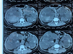 Cắt bỏ khối u thận nặng tới 2,8 kg