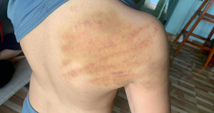 Phú Yên: Người dạy học thêm tại nhà đánh học sinh lớp 5 bầm tím lưng