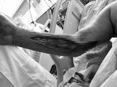 Căn bệnh khiến chàng trai 25 tuổi phải đoạn chi để giữ mạng sống