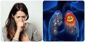 Triệu chứng ung thư phổi giai đoạn đầu hay bị nhầm lẫn với bệnh khác