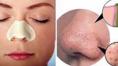Bật mí 7 cách trị mụn đầu đen hiệu quả tại nhà