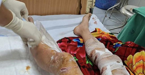 Nam sinh ở Lào Cai bị chó thả rông cắn gây thương tích nặng