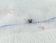 Nghịch súng hơi, bé trai bị đạn găm vào xương sọ