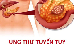 Triệu chứng ung thư tuyến tụy giai đoạn đầu