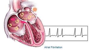 Biện pháp giảm nguy cơ mắc bệnh rung tâm nhĩ
