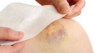 Dấu hiệu ung thư giai đoạn đầu 