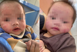 Bé gái 7 tháng tuổi bị bỏ rơi ven đường, gương mặt chi chít vết muỗi đốt