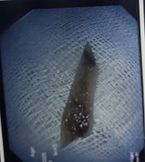 TP.HCM: Cụ bà hóc xương vịt đâm xuyên 2 thành thực quản