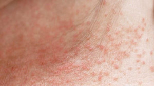 Cha mẹ nên làm gì khi trẻ mắc ban nóng, rôm sảy?