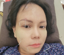 Việt Hương bị méo mặt, phải châm cứu