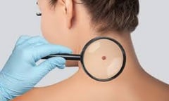 Những nốt ruồi son cảnh báo cơ thể đang mắc bệnh