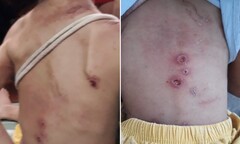 Bé trai ở TP.HCM có dấu hiệu bị bạo hành: Bệnh trạng còn nặng, tiếp tục hồi sức