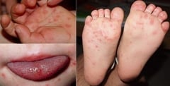 Nhiều trẻ Hà Nội nhập viện do mắc bệnh tay chân miệng, có ca biến chứng nặng