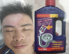 Dùng nước thông cống siêu tốc, nhiều người bỏng phải nhập viện cấp cứu