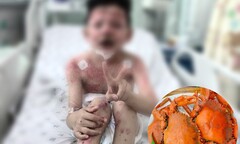 Sau 2 ngày ăn cua, bé trai nguy kịch 