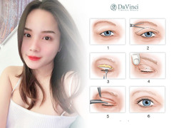 Chuyên gia Viện thẩm mỹ DaVinci chia sẻ bí quyết sở hữu mắt 2 mí đẹp tự nhiên