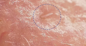 Những sinh vật kỳ quái sinh sản trên da người