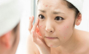 Mùa hè ăn gì để da khoẻ đẹp, tránh nổi mụn?