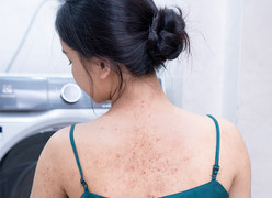 Chia sẻ của bác sĩ Đào Xuân Hưởng về phương pháp trị viêm nang lông 