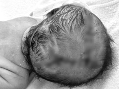 Em bé chào đời phải nhập viện khâu 21 mũi vì sai lầm của người nhà