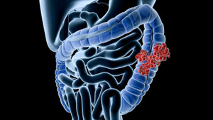 Nghiên cứu mới 'điểm danh' 4 dấu hiệu ung thư đại tràng ở người trẻ tuổi 