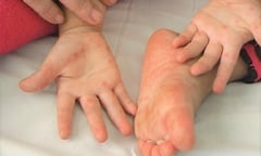 Bé trai 1 tuổi ở Đắk Lắk tử vong vì bệnh tay chân miệng